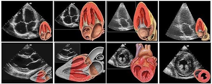 CORONARY-ANGIOPLASTY-image