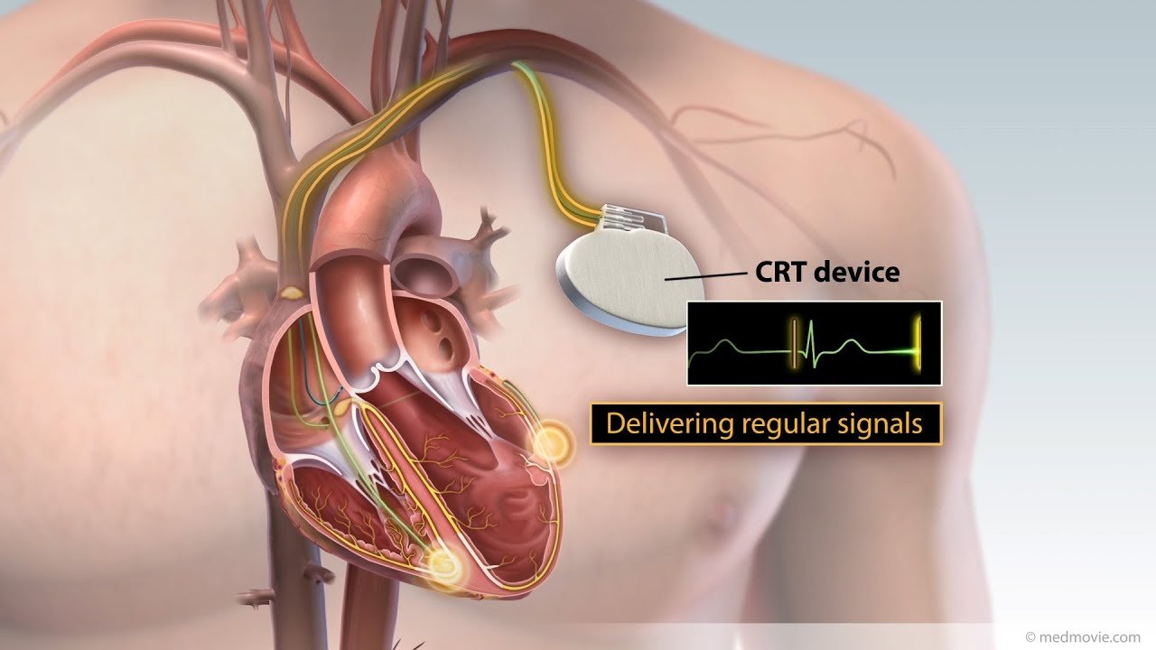 CORONARY-ANGIOPLASTY-image