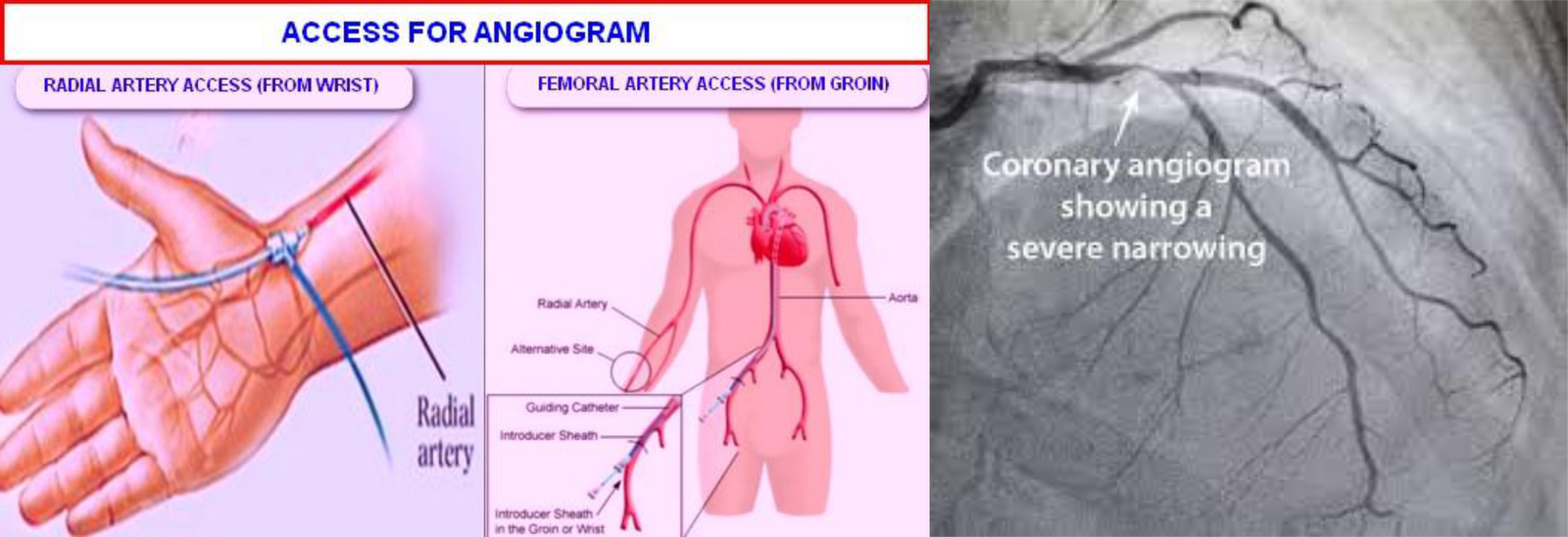 CORONARY-ANGIOPLASTY-image