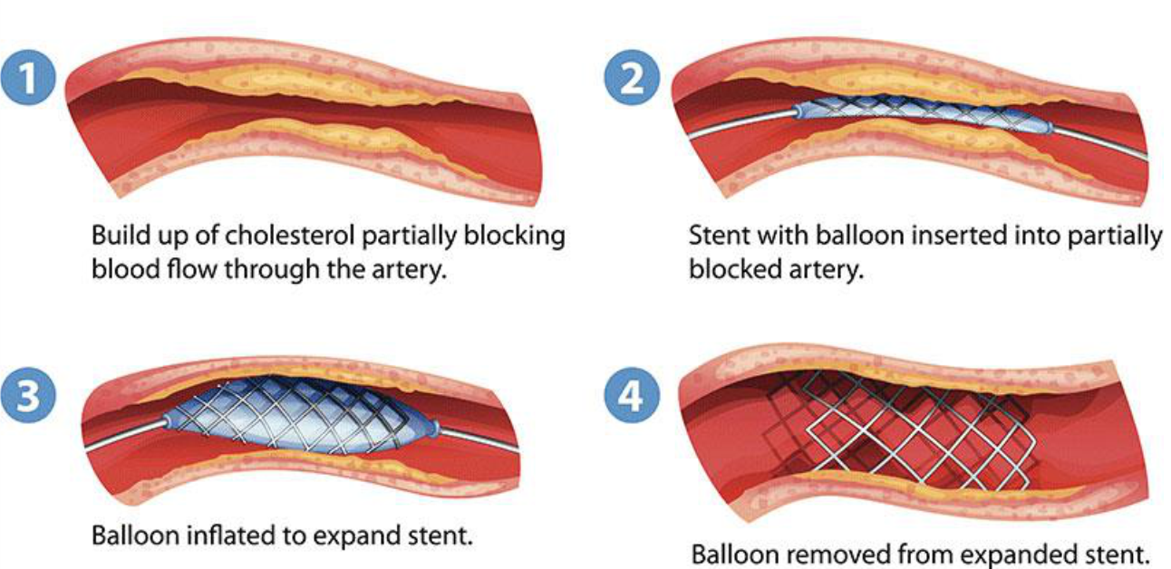 CORONARY-ANGIOPLASTY-image