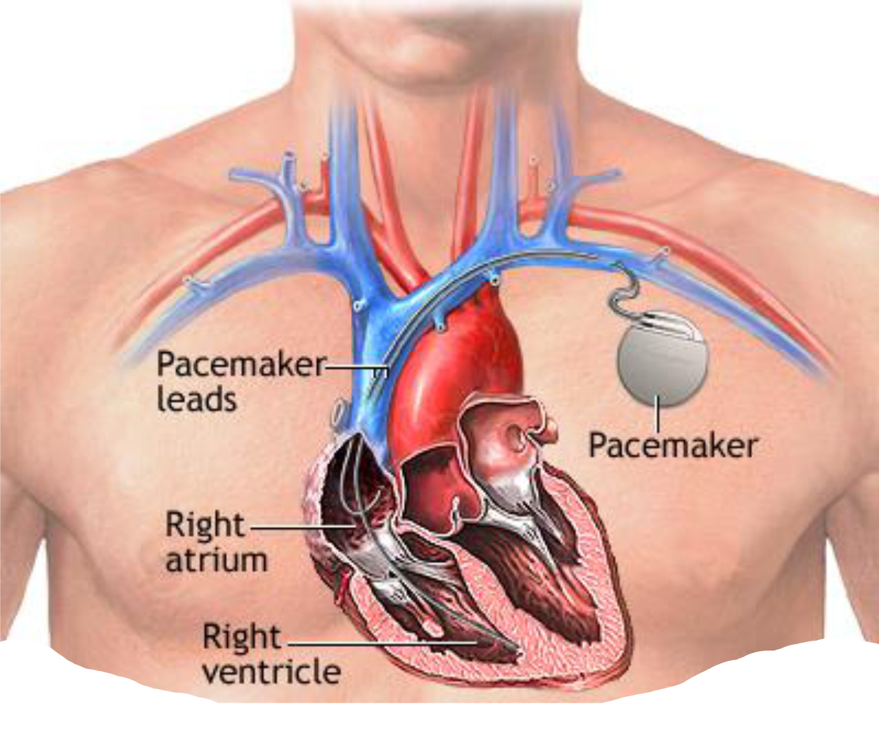 CORONARY-ANGIOPLASTY-image